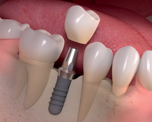 Single-Dental-Implant